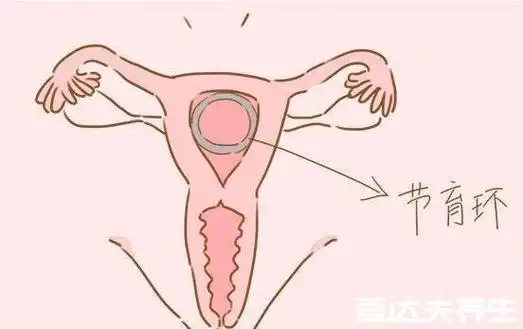 避孕环它的原理是不断的动作刮擦女性的子宫内壁,造成子宫的无菌炎症