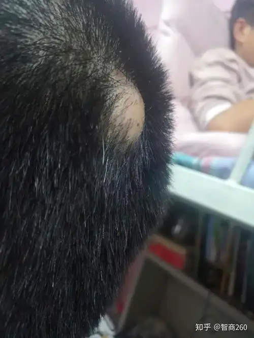 如何乐观的面对毛囊炎导致的头部多发囊肿