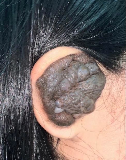 案例秀先天性耳廓巨大色素痣