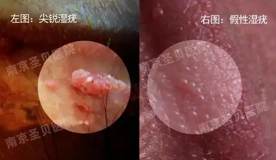 男性患者如果自己的"小弟弟"上面出现一些颗粒样的丘疹或增生,的确有