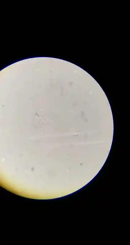 讨论尿酸盐结晶嫩们听说过么