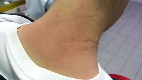 求问脖子后通红一片是什么情况?有点刺痛!