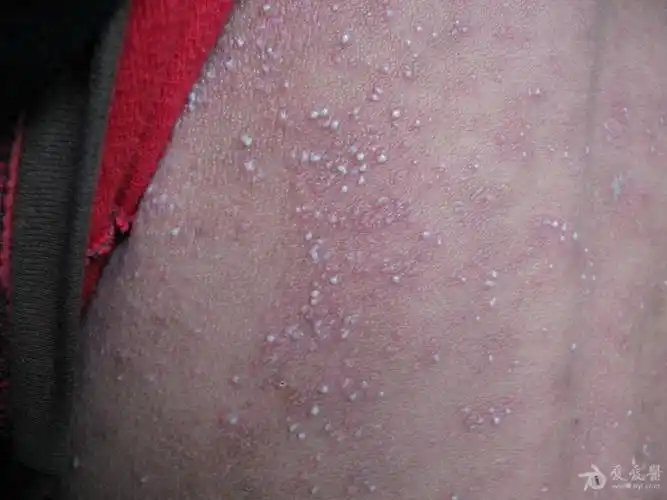 全身脓疱急性泛发性发疹性脓疱病