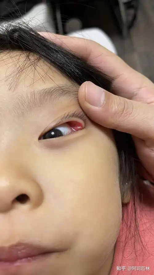 孩子眼皮长了个小包