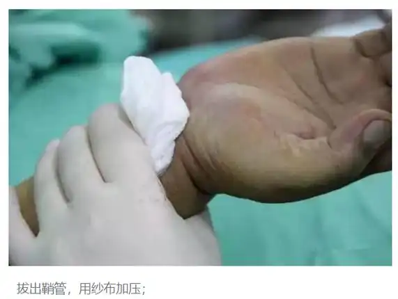 24张图带你了解真实的心脏支架