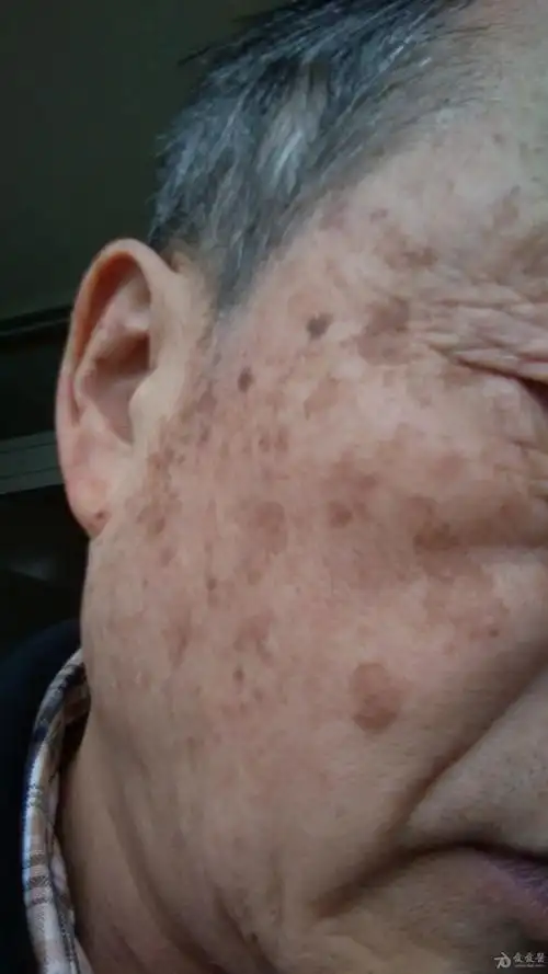 这种面部皮损该如何诊断