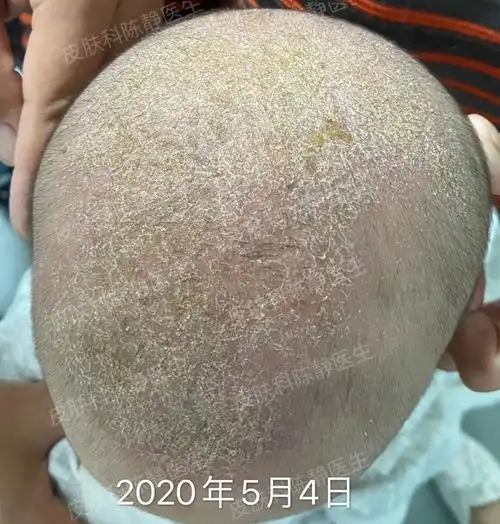 婴儿脂溢性皮炎能用激素吗
