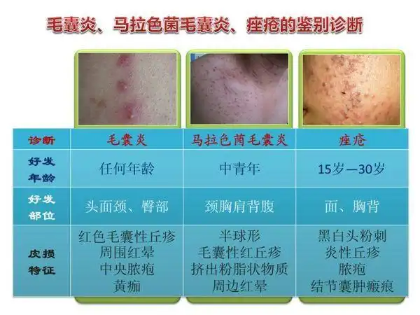 马拉色菌毛囊炎 怎么治? - 好大夫在线