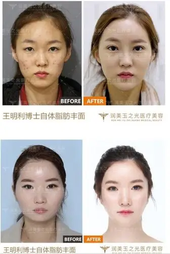 面部填充效果对比图