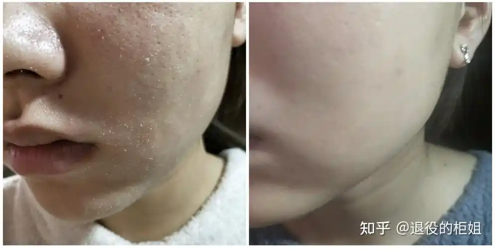 皮肤缺水一般有哪些表象?秋冬皮肤干燥脱皮爆皮怎么办? - 知乎