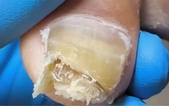 指甲里都长小虫子了