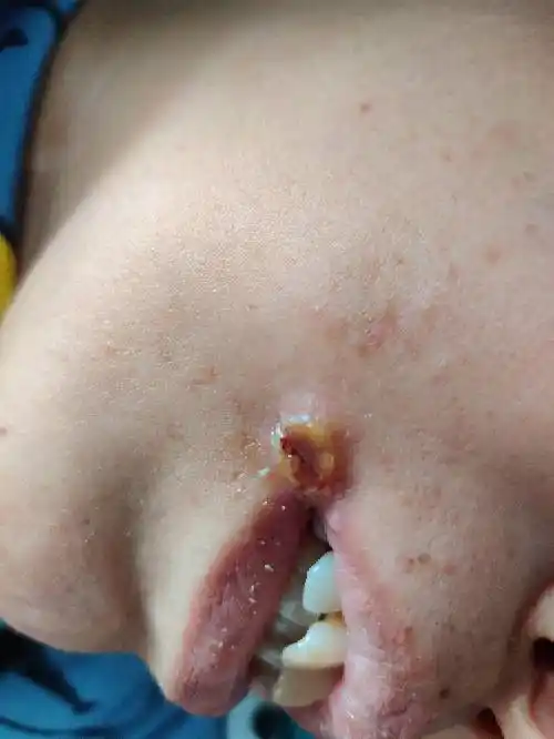 嘴角烂是口腔溃疡吗