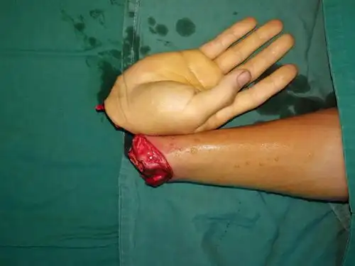 右腕离断伤