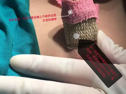 包皮吻合器手术后拆绷带事项提醒