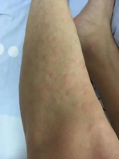 皮肤过敏,昨天吃了龙虾,晚上就这样了