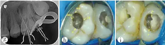 上颌融合磨牙根管治疗1例报告