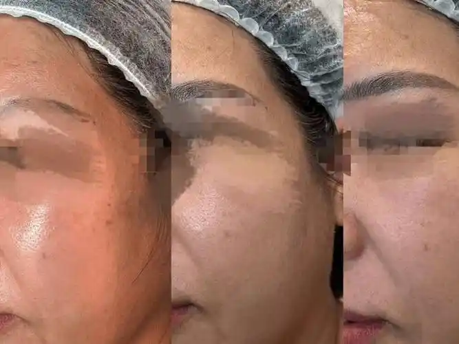 女明星也逃不过的毛孔粗大,到底怎么做才能远离"橘皮脸"?