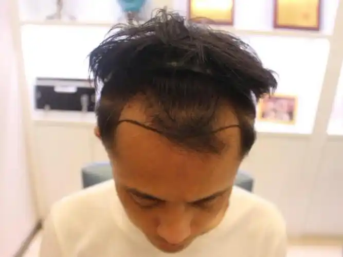 秃秃的鬓角真的很显老,从我的经历来看深有体会,植发_圈子-新氧美容