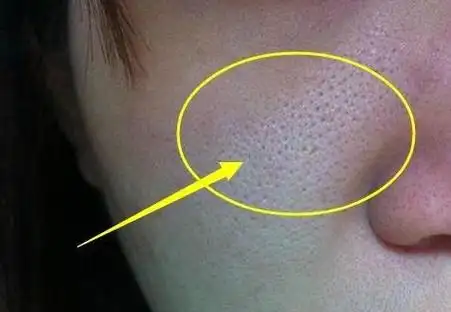 满鼻子的"黑芝麻"难看死了,去黑头这4步,养成光滑小翘鼻(毛孔挑芝麻