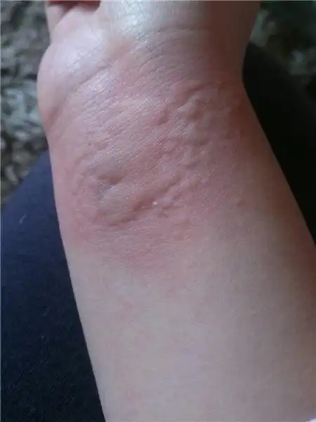 寒冷性荨麻疹手背皮肤病图片