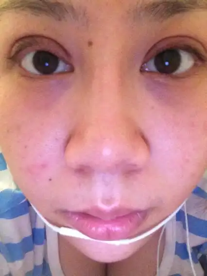 问:双眼皮术后眼睑上翻能恢复吗?有谁跟我情况一样,现在恢复了吗?