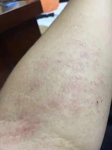 为什么这几天手臂上出现了这种? 怎么办