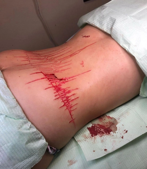 背部哥特城堡肉雕纹身割皮纹身及恢复后图片4