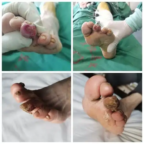 井陉县医院骨伤科实施胫骨横向骨搬运技术治疗糖尿病足成效显著