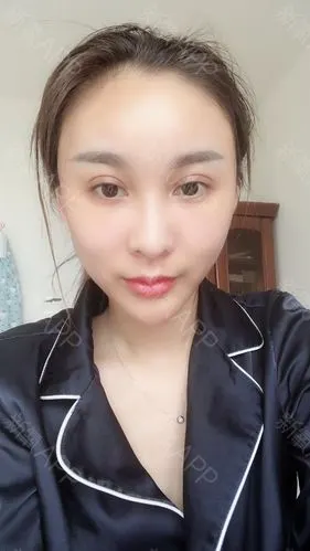 自体脂肪面部填充