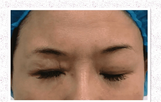 眼睑下垂手术失败图片第三张不是真的吧