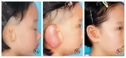 先天性耳廓畸形的成因有哪些哪家医院做耳再造效果好