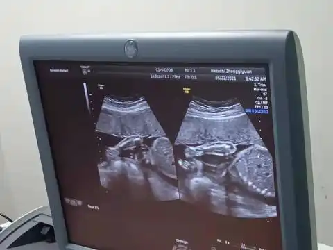 照四维的时候拍的,有没有会看男孩女孩的?第一胎,超好奇