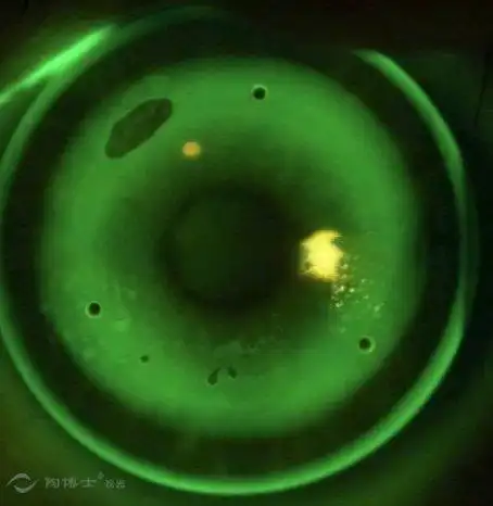 戴镜片后眼珠大幅度乱转,以至于导致有空气进入产生气泡1.