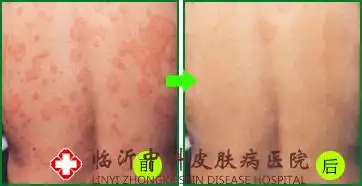 【荨麻疹】中医汉方生物脱敏疗法:改变过敏体质 根治荨麻疹