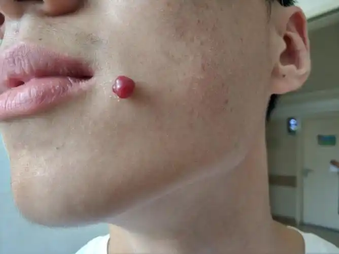 易出血的红色皮疹_化脓性肉芽肿 - 好大夫在线