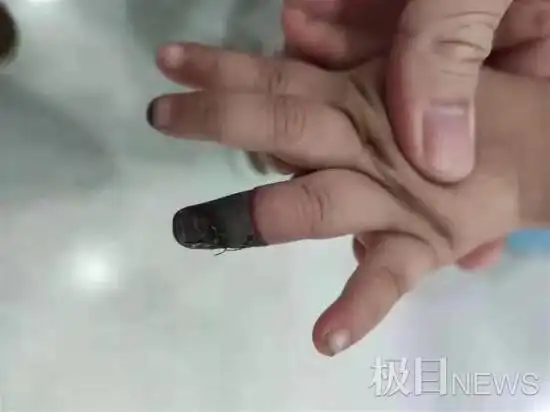 家人错误包扎致3岁女童手指坏死 无知的奶奶