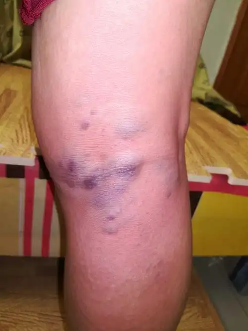 血毒/皮肤病/脓疮