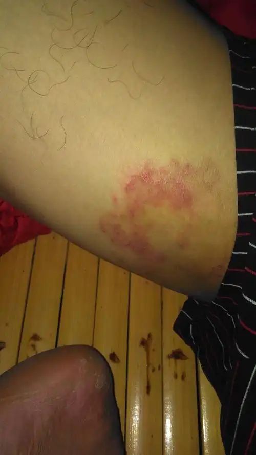 大腿两侧这个很痒,但我没什么病啊,请大家尊重我,求好心人推荐一款