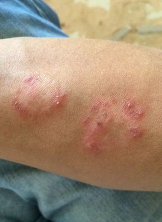 体股癣初期现象图片8