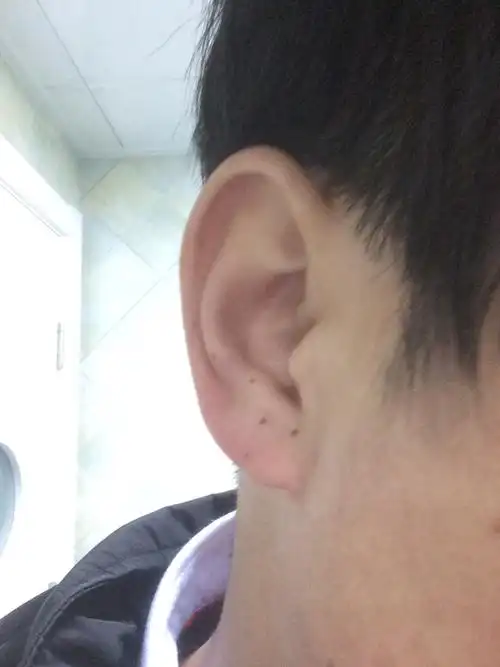 我耳朵耳垂两颗痣是小时候就有的,上面几颗都是近几年才有的,有什么