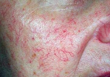 脸上有红血丝就是敏感肌吗?