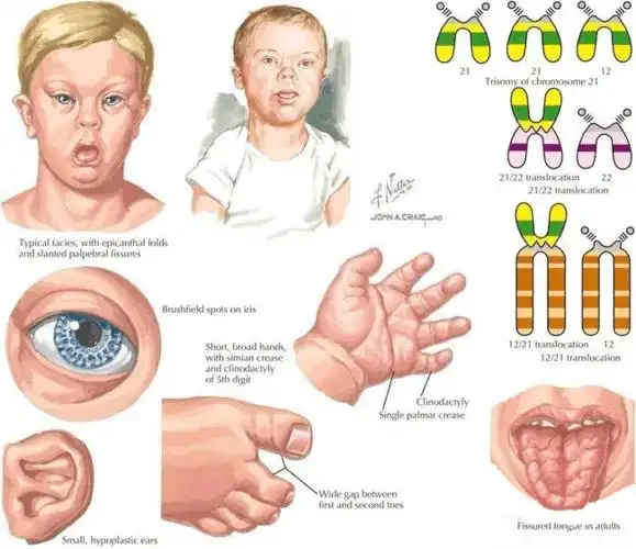 橄榄树生命染色体异常之唐氏综合征