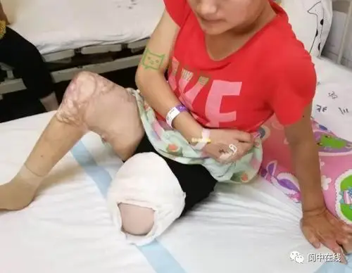 3岁双腿残疾,17岁父亲去世又被截肢,救救这个阆中女孩!