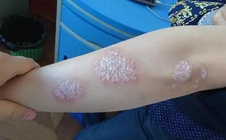 otezla治疗中度至重度斑块状牛皮肤癣