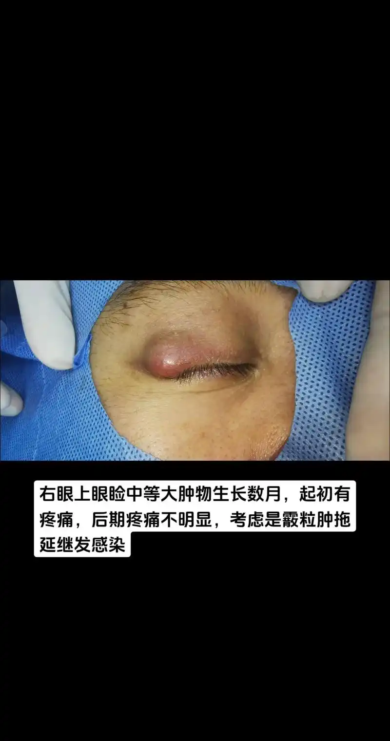 霰粒肿 ——继发感染脓肿,尽量不要拖延治疗. - 抖音
