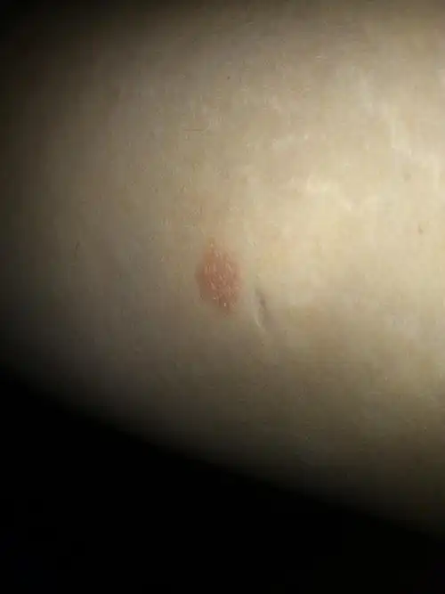 各位大神看看小弟身上怎么了出的一块块的癣这是皮癣吗