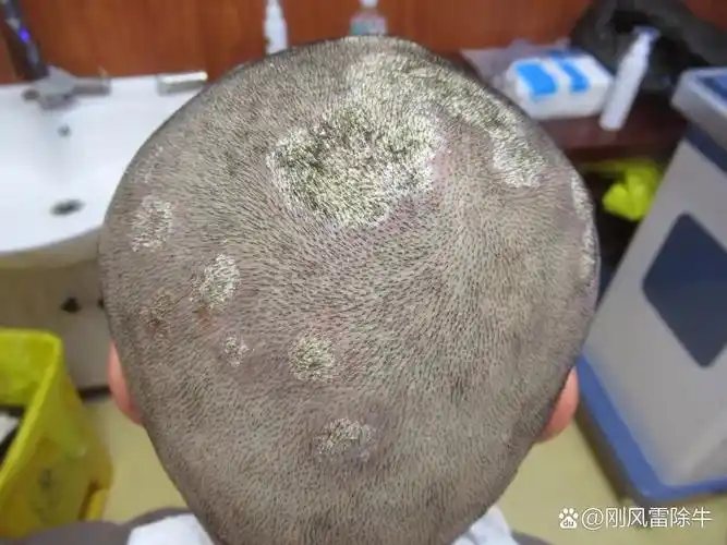 头上一直反反复复的牛皮癣,彻底结束了. 整整五年的困扰再也不复发.