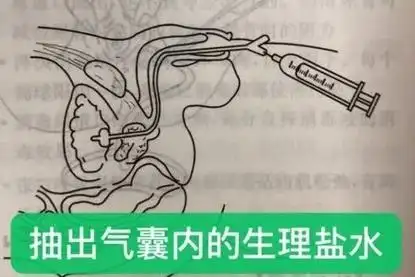 当时那叫个心碎啊!后来用膀胱镜才将那半截尿管给取出来!