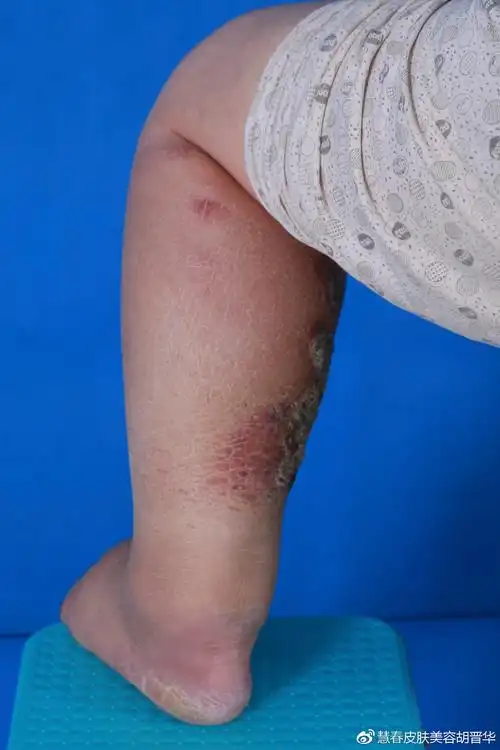 慢性复发性丹毒继发小腿象皮肿一例