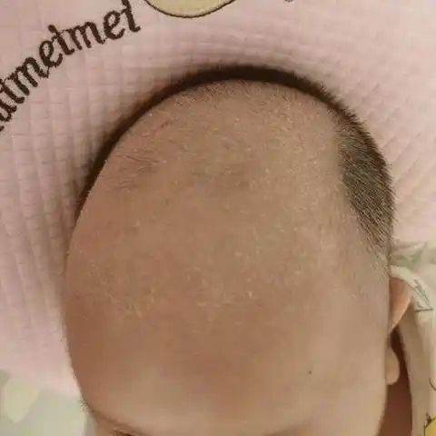 宝宝3个月18天了,头皮和额头上起皮,跟头皮屑一样,用植物油泡完后洗掉